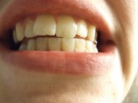 Teeth - Flickr Mike Burns